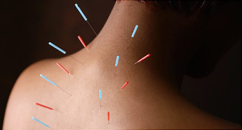 How to Choose the Right Acupuncturists for Your Health Needs